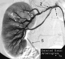 right kidney - renal arteriogram